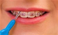 Six Tips for Cleaning Your Teeth With Braces