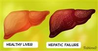 What is hepatic failure?
