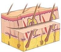 What Is a Skin Graft?
