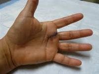 Finger and Hand Surgeries