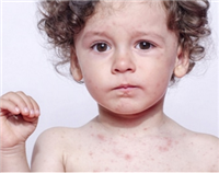 Infectious diseases in children