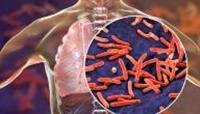 Learn about the cure rate for tuberculosis and the