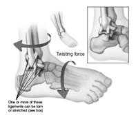 How to Care for a Sprained Ankle
