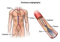 What is cardiac catheterization?