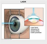 What is Refractive Surgery