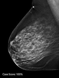 ProFound AI for 2D Mammography