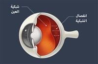 أمراض الشبكية - الأعراض والأسباب