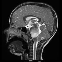 Mutations Synergize in Pediatric Brain Cancer