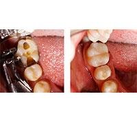 Endodontics,