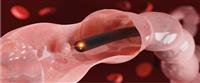 When should a colonoscopy be done?,,,