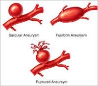 Aneurysm