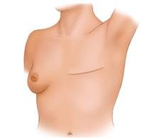 Breast cancer surgery Types