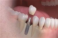 How to replace lost teeth