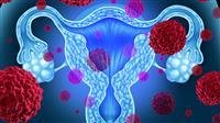Cervical cancer.