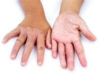 Peeling skin