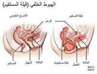 Posterior vaginal prolapse (hernia)