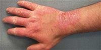 Skin dryness