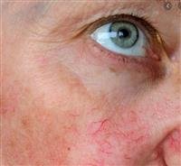 What’s Causing Broken Blood Vessels on My Face?