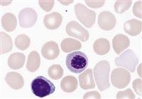 PEDIATRIC HEMATOLOGY AND HEMOGLOBINOPATHIES