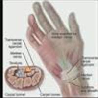Carpal Tunnel Syndrome..