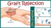 Transplant rejection