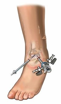 Ankle Surgery: Types, Risks & Recovery
