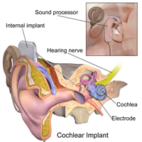What is Cochlear implants?