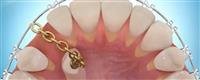 Types of orthodontics