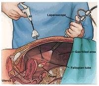 Laparoscopic Surgery for Endometriosis.