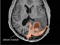 Meningioma