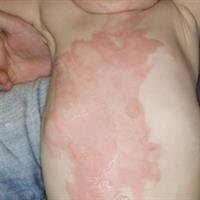 Pediatric Burn Center and Surgery