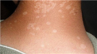 Infectious skin diseases