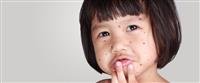 Smallpox,,