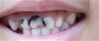 Smallpox