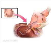 C-section