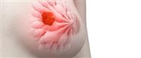 breast cancer....
