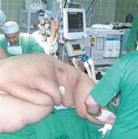 تصغير المعدة وتحوير مسار الصفراء والبنكرياس