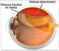 Laparoscopic Method Gallbladder Removal