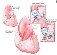 Aortic root surgery