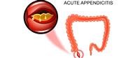 acute appendicitis.