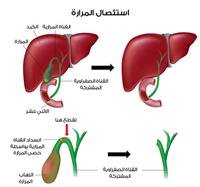 استئصال المرارة .