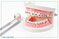 What Are Dental Implant