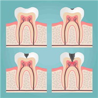 What Is Pulpitis