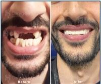 ابتسامة هوليوود