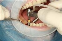Dental - Implants...