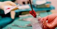 breast biopsy,