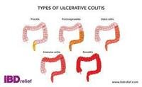 Ulcerative Colitis..