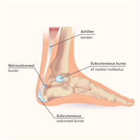Achilles Tendon Bursitis