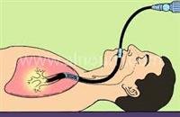 Thoracoscopy.