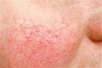 Ataxia-Telangiectasia